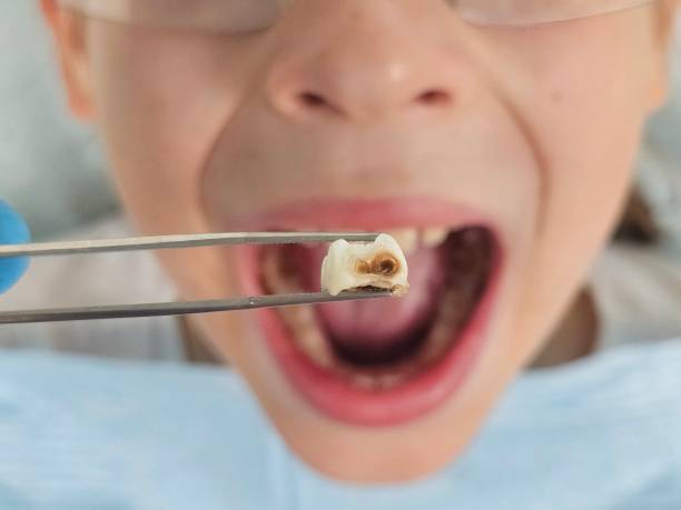Best Emergency Wisdom Teeth Removal in Strodes Mills, PA